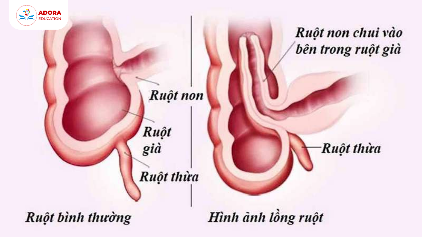 lồng ruột ở trẻ là gì