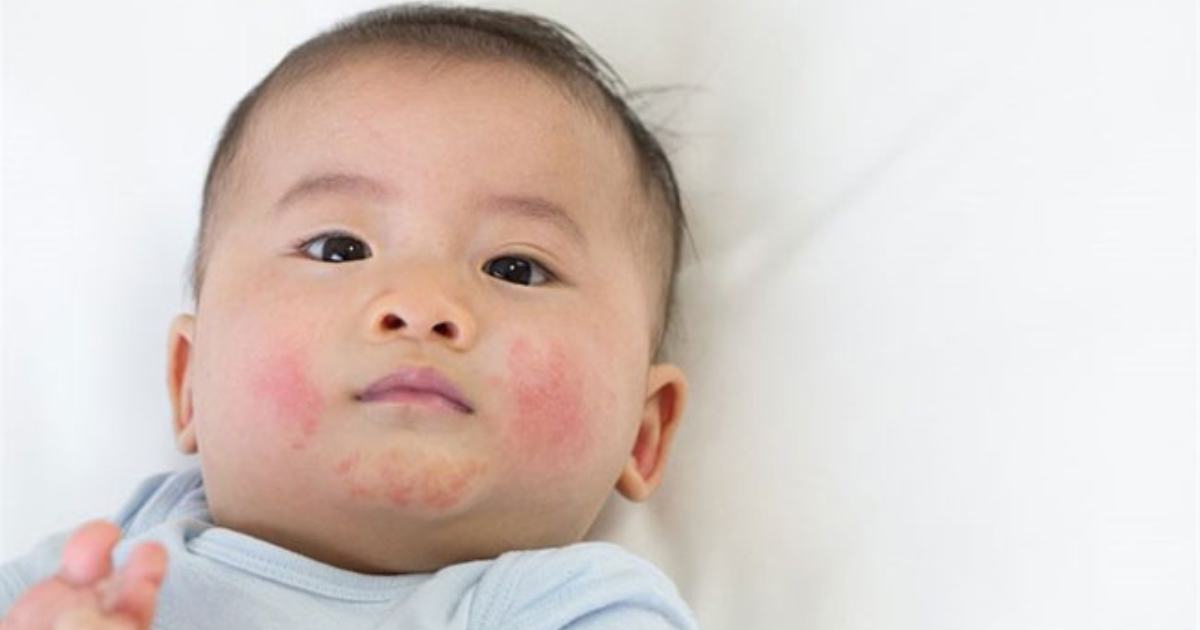 chàm sữa là gì ở trẻ sơ sinh
