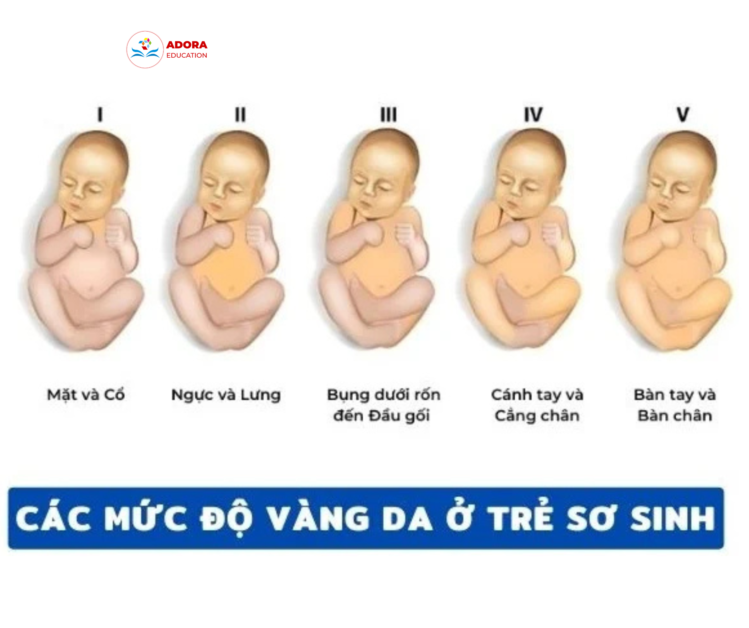 các mức độ vàng da ở trẻ sơ sinh
