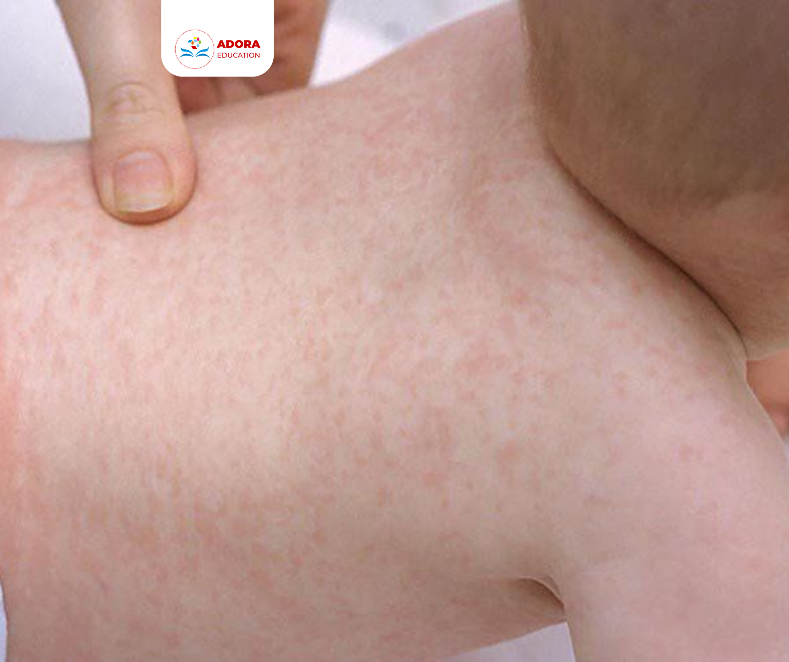 sốt siêu vi ở trẻ là gì
