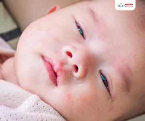sốt xuất huyết ở trẻ em