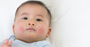 chàm sữa là gì ở trẻ sơ sinh
