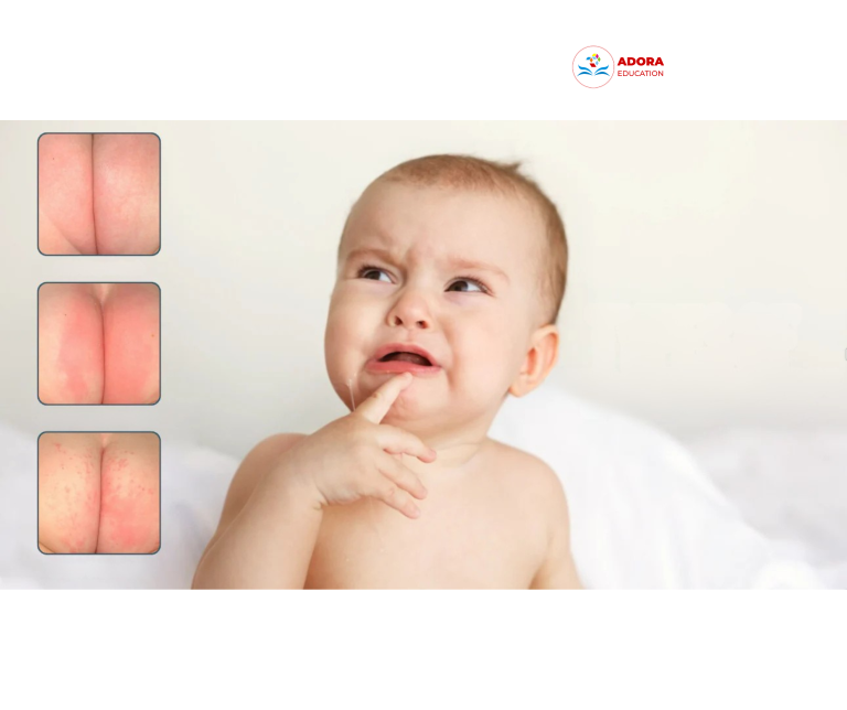 trẻ sơ sinh bị hăm là gì